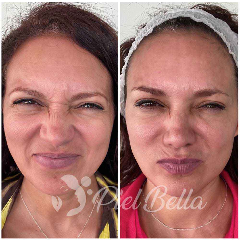 resultados con botox capilar sesiones necesarias