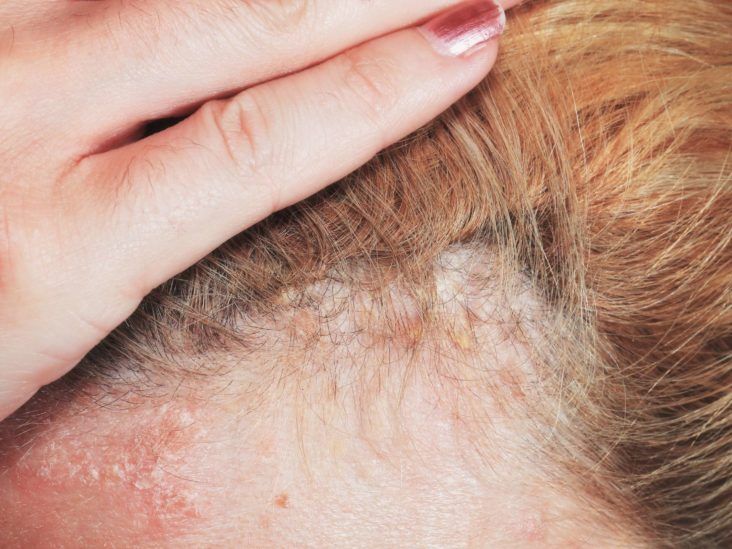 mascarilla capilar dermatitis alivio para tu cabello